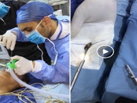 مستشفى بنها الجامعي تنقذ حياة طفلين وتستخرج «لعبة أطفال» و«قشرة لب» من حنجرتهما